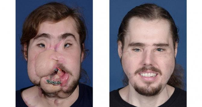 Trasplante de cara de Cameron Underwood / NYU LANGONE HEALTH