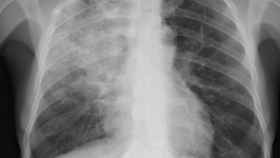 Radiografía de un paciente con neumonía / EUROPA PRESS