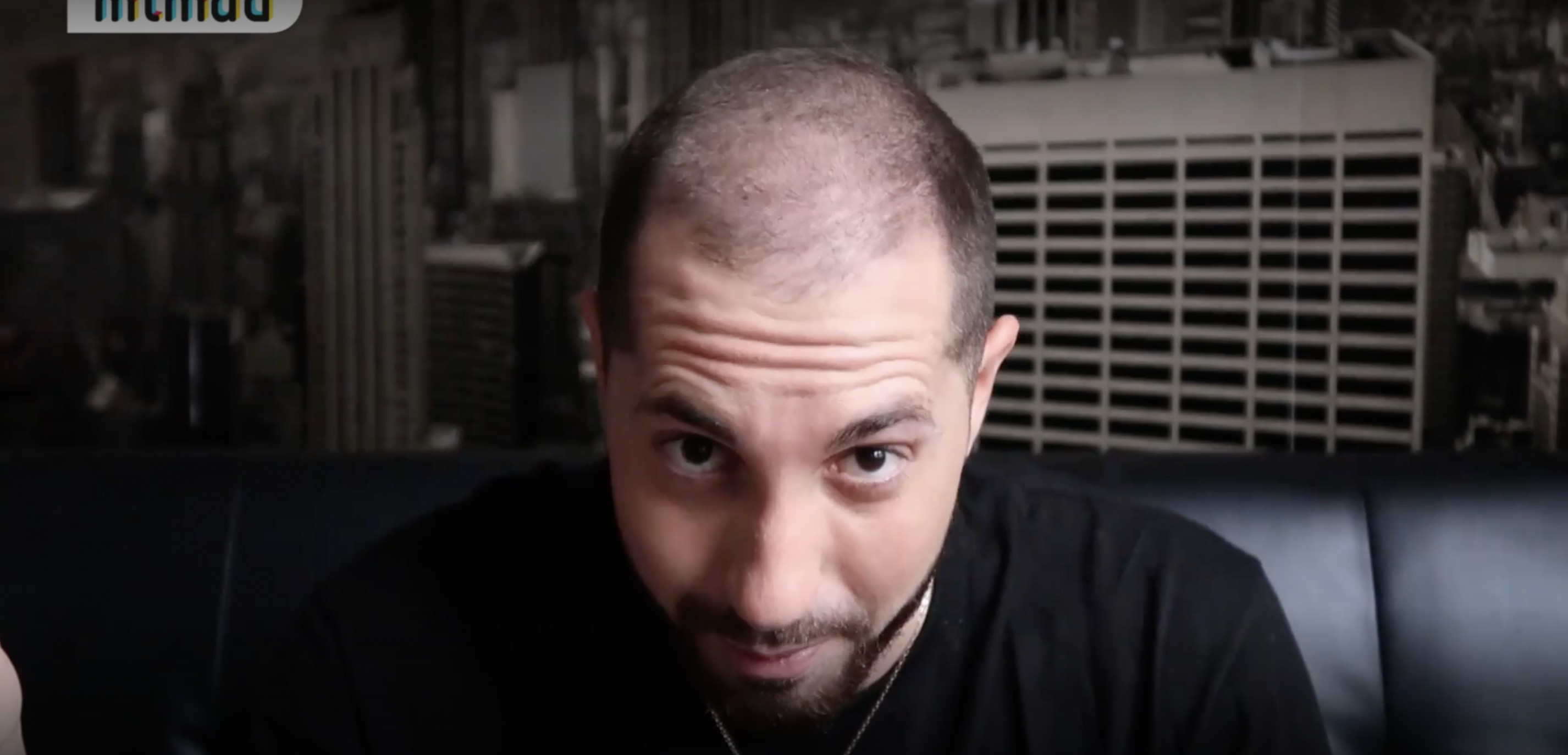 Pablo Moya muestra el resultado de su injerto de pelo / MTMAD