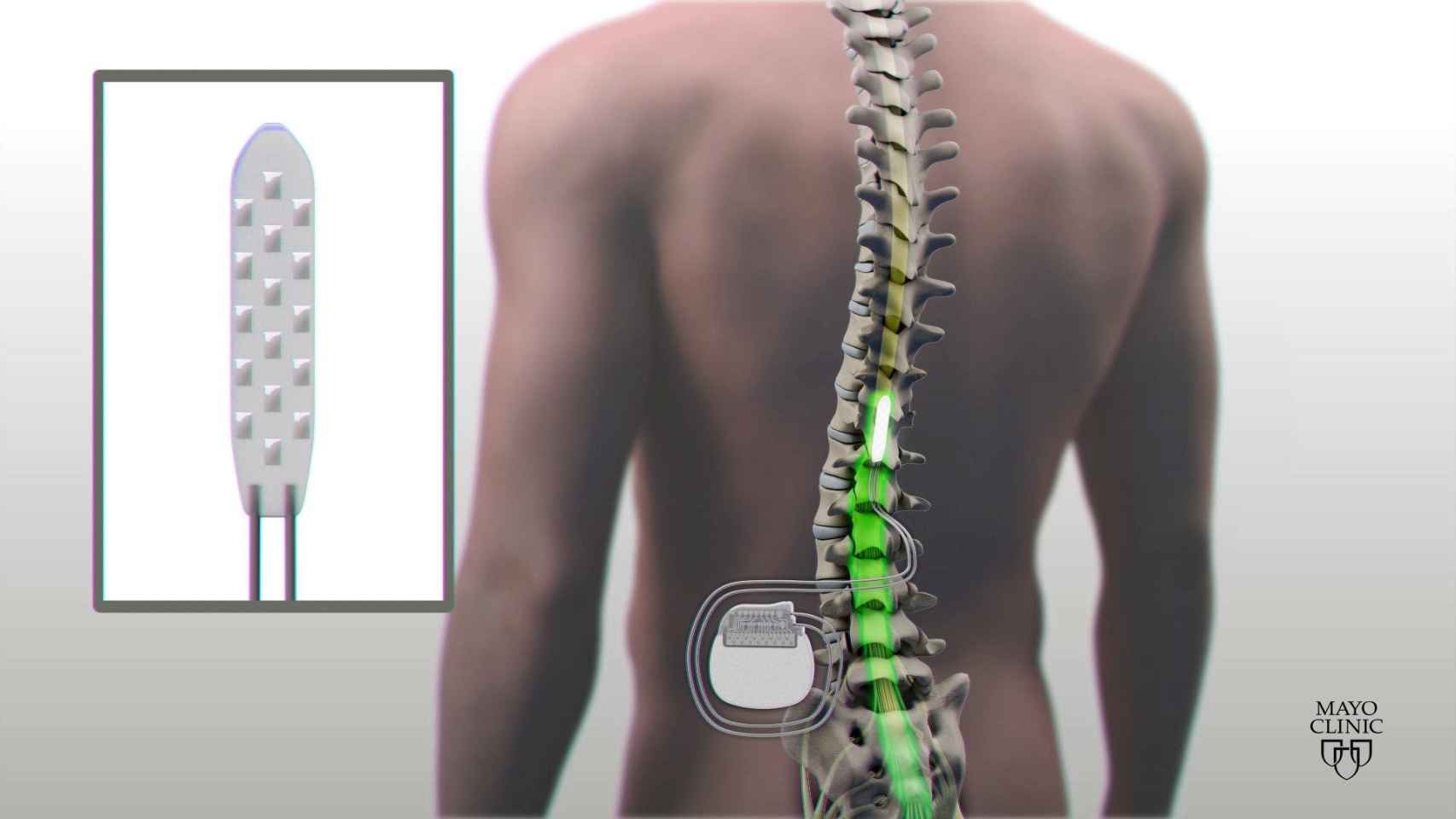 Ilustración que muestra el dispositivo de estimulación espinal eléctrica que le fue implantado a un paciente con una parálisis completa en sus extremidades inferiores tras lesionarse la médula espinal / Clínica Mayo
