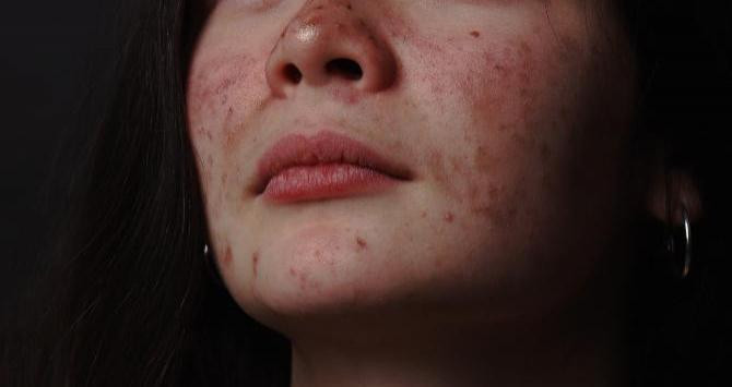 Joven con acné, para cuyo tratamiento se usa la acupuntura / Megan Bagshaw en UNSPLASH