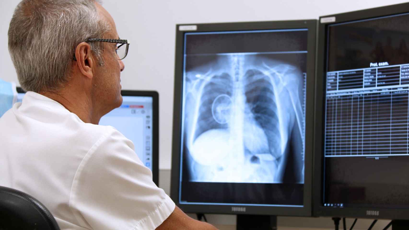 La mayoría de nódulos pulmonares suelen ser benignos