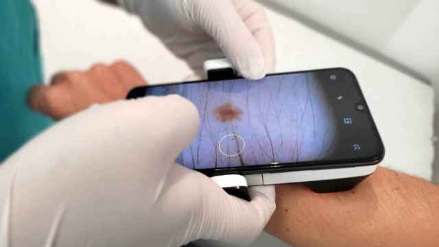 Un dermatlogo observa una lesin cutnea desde el mvil. La teledermatologa diagnostica en 48 horas / QUIRNSALUD