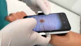 Un dermatlogo observa una lesin cutnea desde el mvil. La teledermatologa diagnostica en 48 horas / QUIRNSALUD