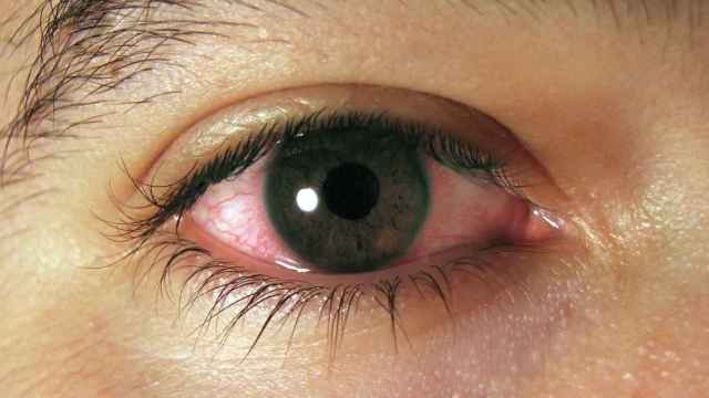 Ojo con signos de conjuntivitis: cuidar la vista durante el verano puede prevenir lesiones / EP