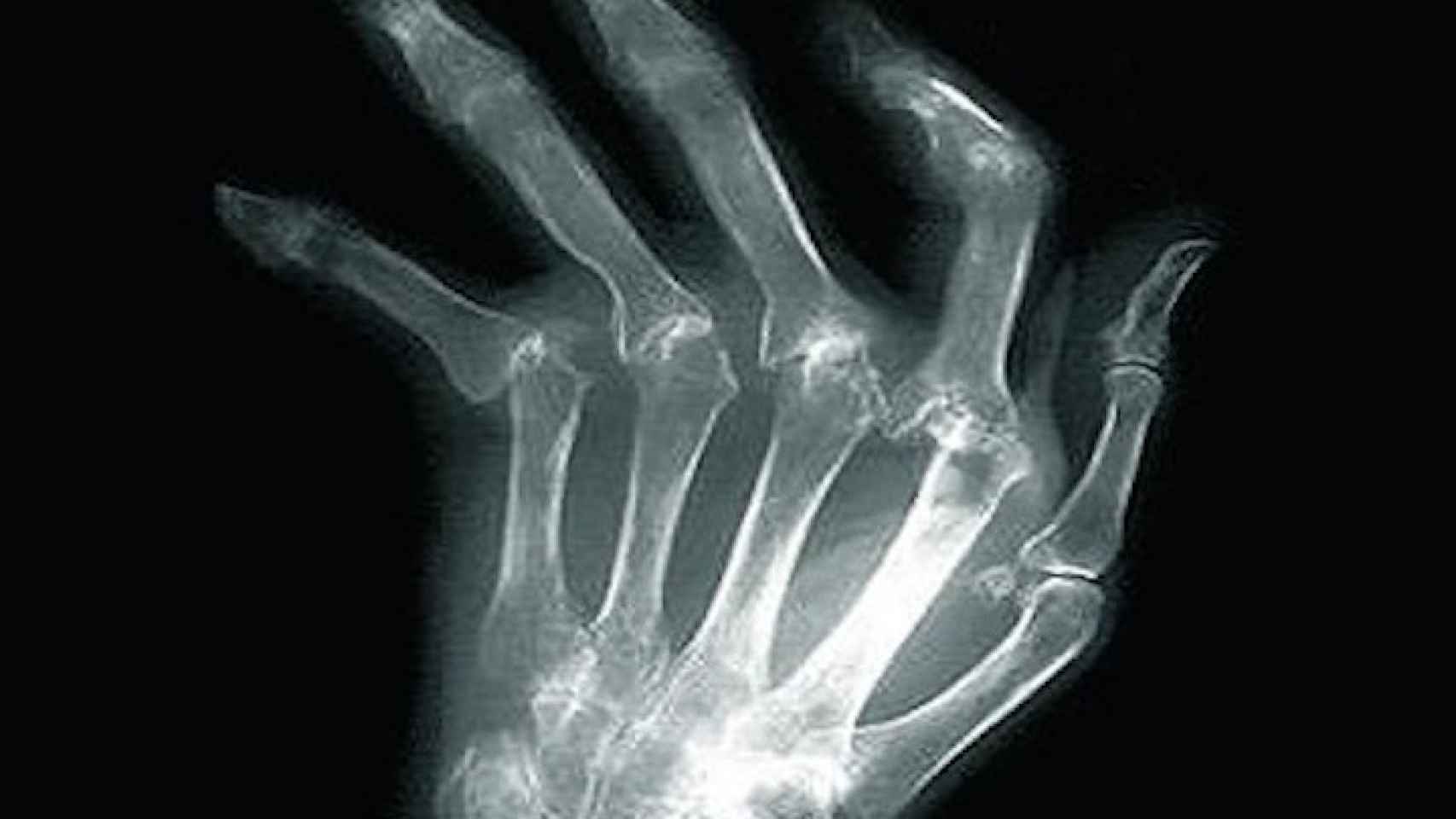 Radiografia de una mano con artrosis
