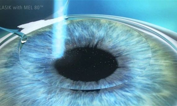 Es una cirugía de los ojos que cambia de manera permanente la forma de la córnea / QUIRONSALUD