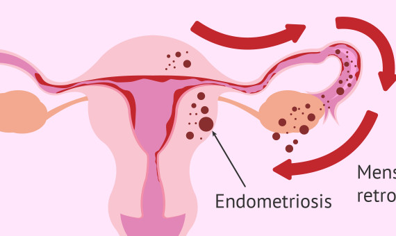 A veces, el endometrio crece fuera del útero, principalmente en los ovarios