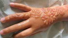 Imagen de la mano de una niña con quemaduras causadas por el henna negra.