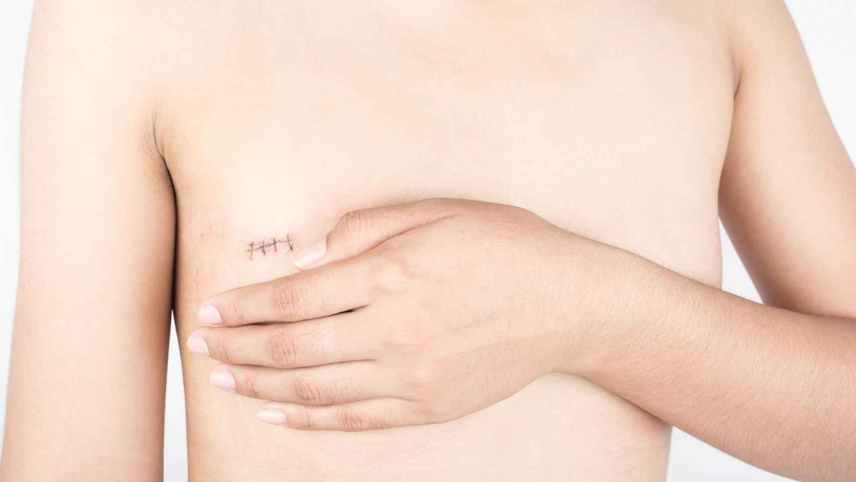 Conservar el pezón es inviable en muchas mastectomías por cáncer de mama / FUNDACIÓN