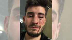 Así le quedó la cara al joven agredido en el metro barcelonés / Twitter