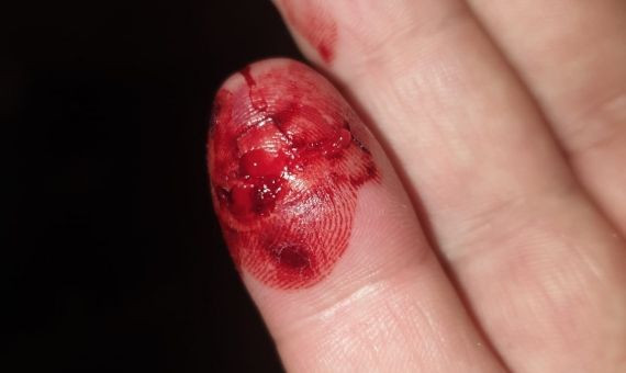 El dedo del vigilante tras la mordedura.