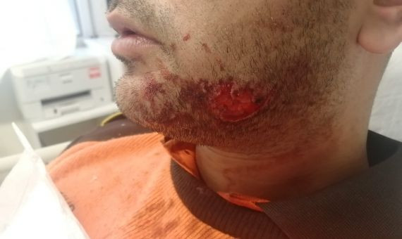 Barbilla del vigilante de seguridad atacado en Urquinaona 