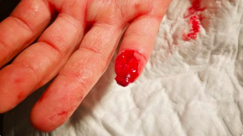 Imagen de la herida en el dedo / HELPERS
