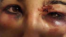 Afectaciones en el rostro de una mujer tras un brutal ataque / MA