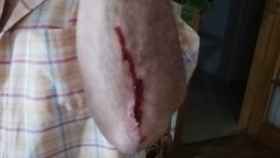 Imagen del brazo herido del exconcejal de ERC, Agustí Soler / TWITTER
