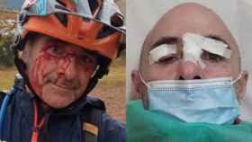 Miquel Castillejos, herido tras caer en una trampa para ciclistas / INSTAGRAM
