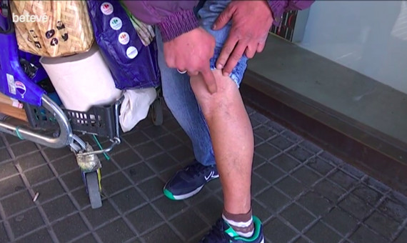 La herida de Nitín en una pierna / BETEVÉ