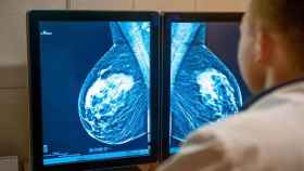 El Hospital del Mar logra predecir el cáncer de mama 20 años antes / ADOBE