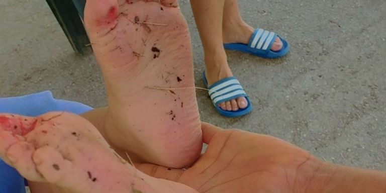 Los pies heridos de un niño, el pasado verano en la Creueta del Coll / betevé