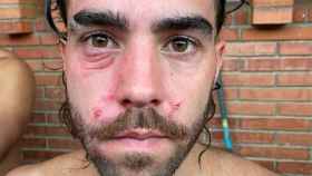 Una de las víctimas agredidas durante el partido Atlanta-El Raval y el Nacional de Barcelona / RR.SS.