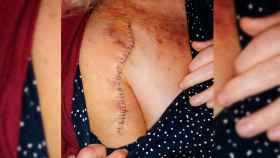 Cicatriz con 32 grapas de la operación de Josefa a raíz de la caída por una acera en mal estado de Barcelona / CEDIDA