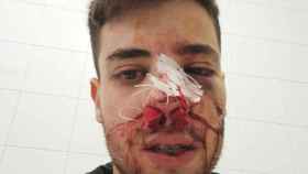 Así le quedó la cara a Pau, el jugador del Vilassar, tras la brutal agresión en un partido de hockey con el Arenys / CLUB VILASSAR HOQUEI