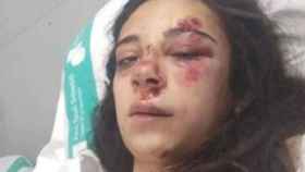 La joven herida tras el atropello durante una carrera ilegal en Badia del Vallès / CEDIDA