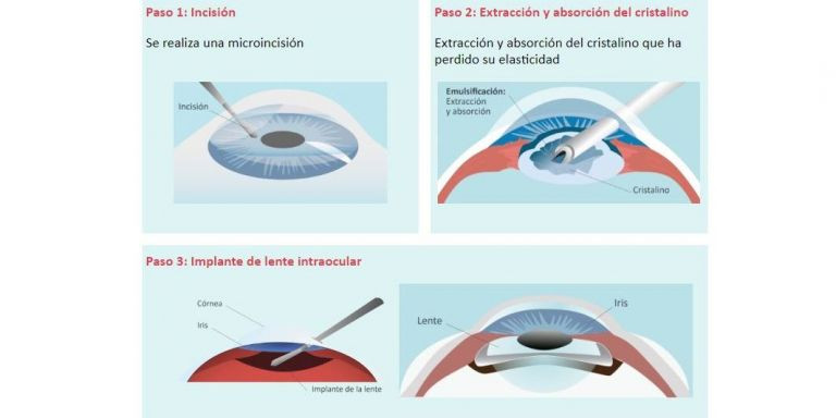 Operación presbicia 2025 lente intraocular opiniones