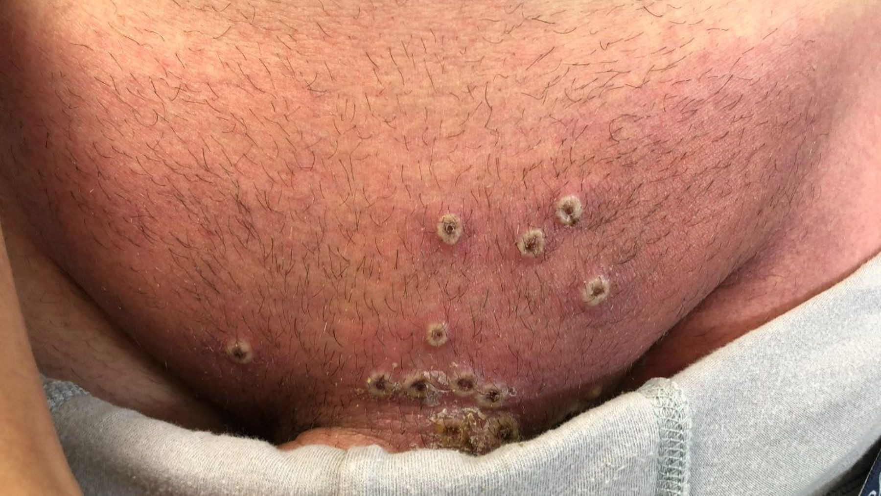 Infección de viruela de mono en el pubis de un paciente / TWITTER