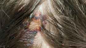 Herida en la cabeza de la víctima por el ataque del perro en Terrassa / DIARI DE TERRASSA
