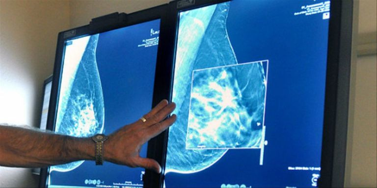 Un doctor observa la mamografía de una paciente / AP - TORIN HALSEY