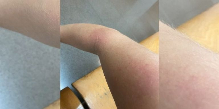 El brazo de la mujer tras la supuesta agresión en el metro / TWITTER