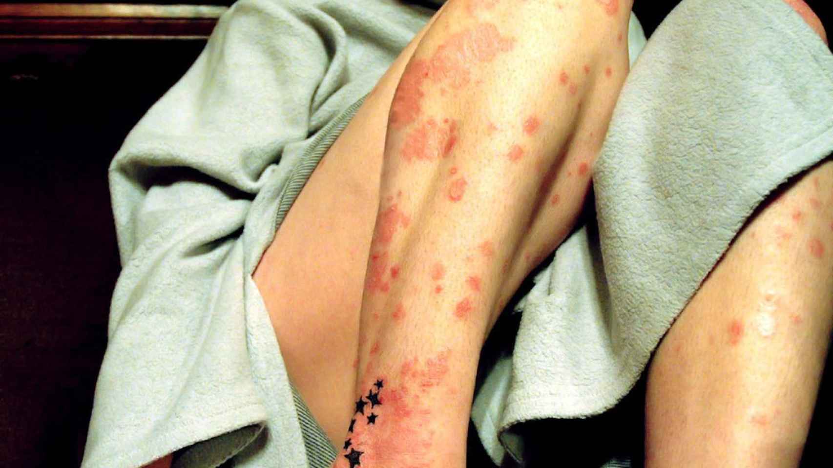 La psoriasis es una enfermedad crónica de la piel cuyos síntomas son muy visibles / FLICKR