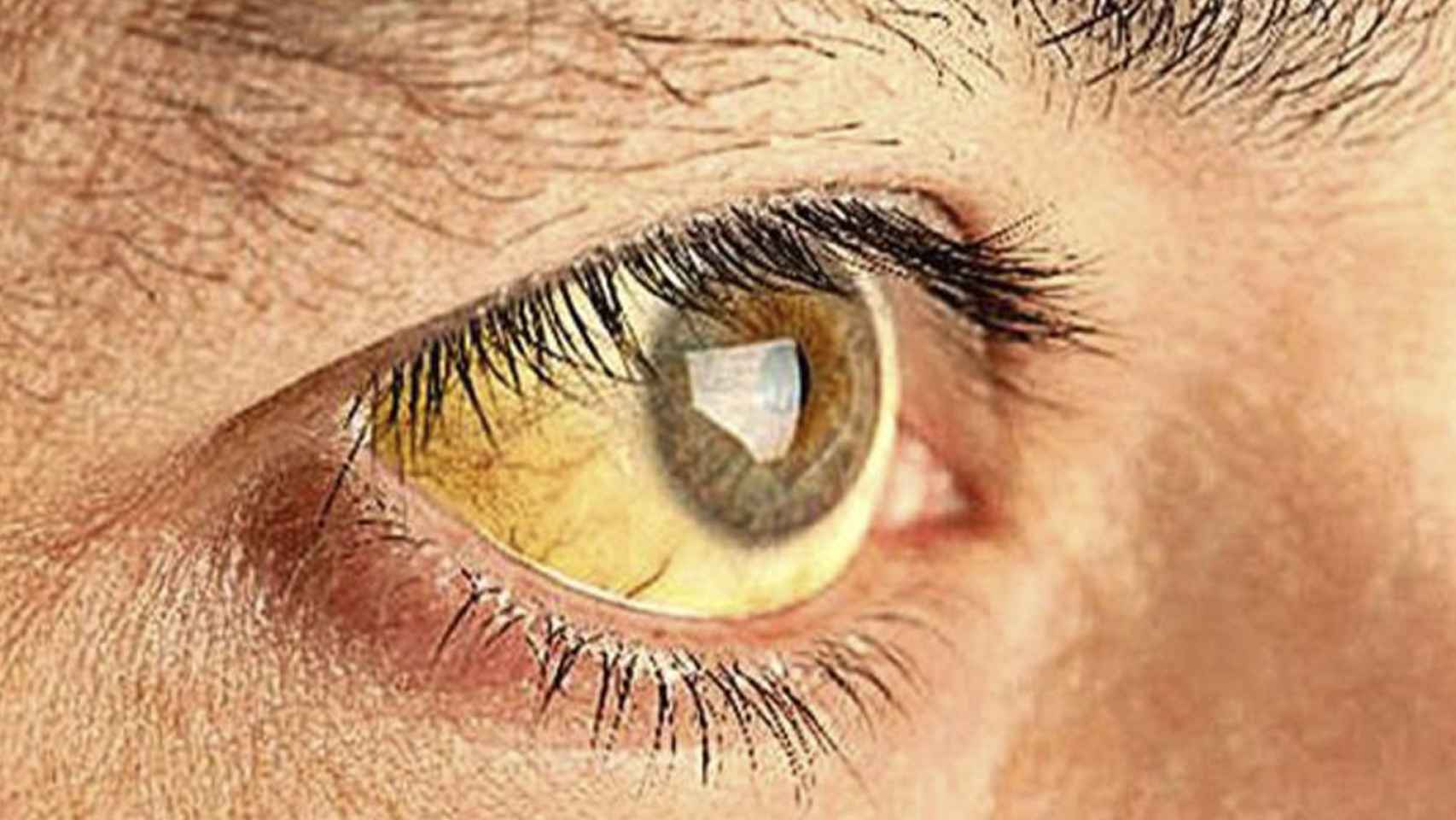 El tono amarillento de los ojos puede advertir de una enfermedad más seria / QUIRÓNSALUD