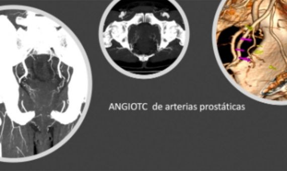 Arterias prostáticas / QUIRÓNSALUD