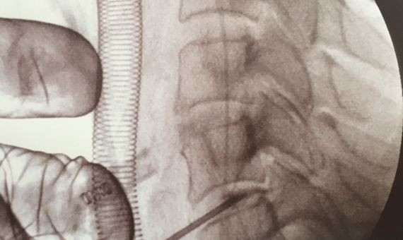 Imagen de la triple hernia cervical