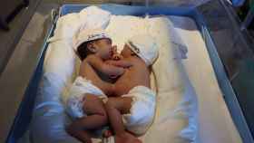 Imagen de las siamesas de Mauritania recién nacidas