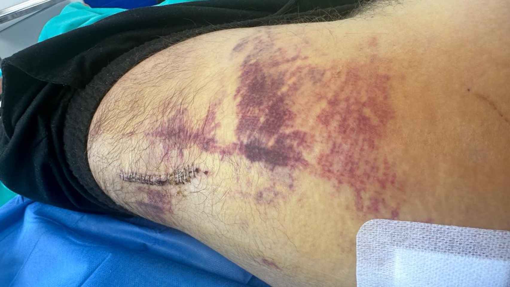 Nacho, herido tras el impacto de una locomotora de FGC