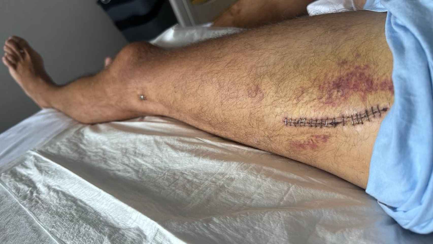 Nacho, herido tras ser arrollado por una locomotora de FGC